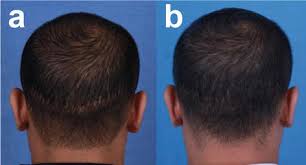Left untreated, folliculitis can cause permanent skin damage including scarring, dark spots and permanent hair loss. Cicatricial Alopecia Intechopen