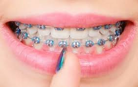 Maybe you would like to learn more about one of these? 10 Tips For Braces Pain Relief Crescent Orthodontics