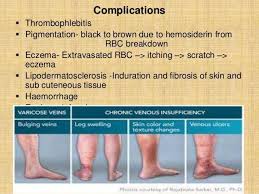 Image result for Lipodermatosclerosis