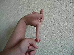 Ehlers Danlos Syndromes Wikipedia