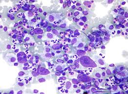 Il linfoma di hodgkin (un tempo denominato linfogranuloma di hodgkin, malattia di hodgkin o morbo di hodgkin), abbreviato con la sigla ldh, è una neoplasia che interessa i tessuti linfoidi secondari come i linfonodi. Linfoma De Hodgkin Wikipedia A Enciclopedia Livre