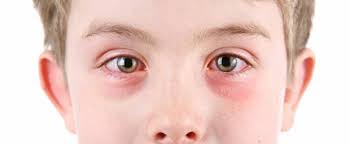 Ekzeme sind entzündungen der haut. Ekzem Am Auge Wie Entsteht Es Und Wie Wird Es Behandelt