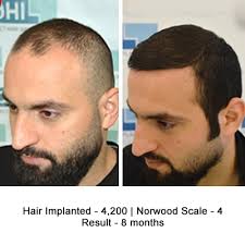 As well as putting the spotlight on a certain medication. Hair Transplant Results Of A Celebrity Hair Stylist Hair Loss Forum Hair Transplant Forums