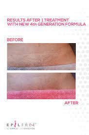 Hair Removal Results Bikini Wax Body Waxing Hair Removal