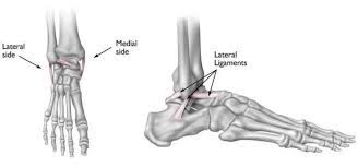 Most sprained ankles occur in the lateral ligaments on the outside of the ankle. Sprained Ankle Orthoinfo Aaos