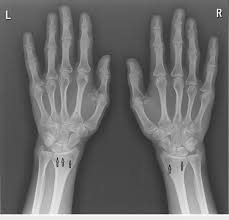 Image result for Hand Growth Plates