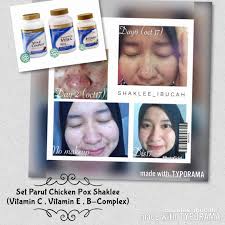 Korang dah pernah merasa kena chicken pox? Parut Chicken Pox Boleh Hilang Dengan Cepat Anda Boleh Amalkan Sendiri Nanti Ziana Eunos