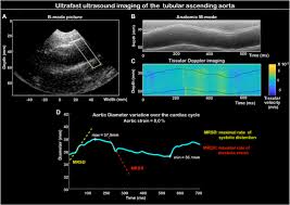 Frontiers | Methods: Aortic wall deformation assessment by ultrafast  ultrasound imaging: Application to bicuspid aortic valve associated  aortopathy