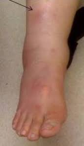 Image result for erythema nodosum