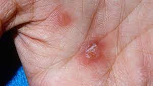 Syphilis Erkennen Und Behandeln Focus Arztsuche