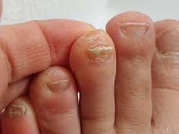 Image result for Onychogryphosis feet