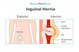 Some causes of a groin strain the human body groin area. Inguinal Hernia Surgery Symptoms And Causes