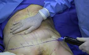 The midriff is the most widely recognized region of the body to be treated by liposuction among the two people. Liposuction Wikipedia