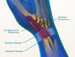 Image result for Tendon Sheath Injection