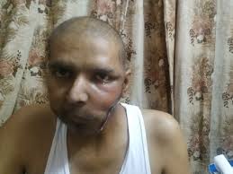 Fight wid cancer last stage