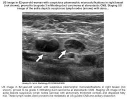 As the cancer progresses, signs and symptoms can include a lump or thickening in or near the if breast cancer spreads, cancerous cells most often appear in the bones, liver, lungs, or brain. Recent Comprehensive Review On The Role Of Ultrasound In Breast Cancer Management Leaders In Pharmaceutical Business Intelligence Lpbi Group