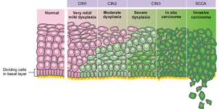 It is due to the abnormal growth of cells that have the ability to invade or spread to other parts of the body. Cervical Cancer Hpv Clinical Features Management Teachmeobgyn