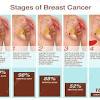 New discovery in breast cancer treatment date: Https Encrypted Tbn0 Gstatic Com Images Q Tbn And9gct Vjpoc9itwcqkyw Sdvzpdcfg8y7swldcqbye27i7taecwtie Usqp Cau