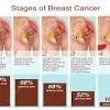 While grading and staging help doctors and patients understand how serious a cancer is and form a treatment plan, they measure two different aspects of the disease. Https Encrypted Tbn0 Gstatic Com Images Q Tbn And9gcqpxlvrjjjbvpby48rcvdzvgbt8gax0iqtftp3wqrwbempqjszg Usqp Cau