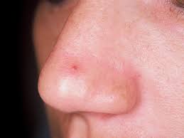 Désigné médicalement par le terme « épistaxis », il est dû à la rupture de petits vaisseaux sanguins à l'intérieur du nez. Laser Couperose Rosacee Dermatologie Face Au Temps