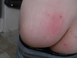 Red bumps on buttocks are likely to form as a result from allergies. Red Bumps Persist Butt And Back Pictures Attached Genital Herpes Simplex Forums Patient