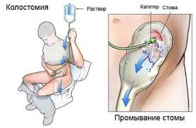 Колостома не всегда ставится пожизненно, временные колостомы встречаются довольно часто. Kolostoma Rol Medicinskoj Sestry V Reshenii Nastoyashih I Potencialnyh Problem U Pacientov S Traheostomoj