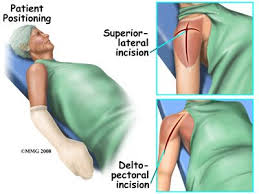 Shoulder Replacement Surgery Is Done Through An Incision On The Front Of Y Shoulder Surgery Recovery Shoulder Replacement Surgery Reverse Shoulder Replacement