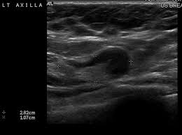 Can ultrasounds miss breast cancer? answered by dr. Inflammatory Breast Cancer Houston Paget S Disease Of The Nipple