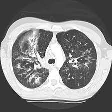 The past 70 years of data analysis, 2017. Cystic Fibrosis Radiology Case Radiopaedia Org