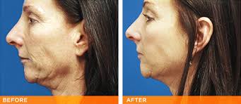 May 11, 2017 · ultherapy procedure your provider, usually a physician or laser technician, will clean the areas they plan to work on of any oil or residue and apply an ultrasound gel. Ultherapy Archives Faboverfifty Com