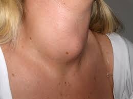5 Throat Cancer Signs And Symptoms With Pictures 2020 Adventis