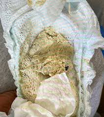 Image result for acholic stools human