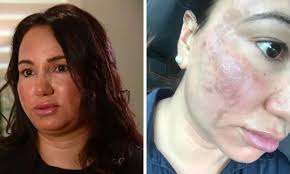 Laser beauty treatment burns, rips skin from woman's face