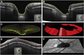 11) optic nerve head and fibre layer imaging for diagnosing glaucoma. Association Of Optic Nerve Head Prelaminar Schisis With Glaucoma American Journal Of Ophthalmology