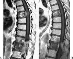 It may grow slowly and it's typically treatable. Multidisciplinary Combined Modality Approach For Cancer Of The Spinal Cord Radiology Key