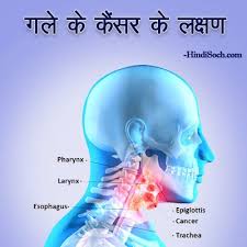 Alcohol is associated with an increased risk of mouth cancer. à¤—à¤² à¤• à¤• à¤¸à¤° à¤• à¤²à¤• à¤·à¤£ à¤• à¤¯ à¤¹ Throat Cancer Symptoms In Hindi