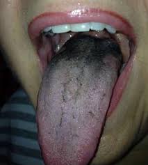 It is essential to carefully remove all the sticky plaque from all surfaces of all the teeth by. Black Hairy Tongue Disease Causes Diagnosis Symptoms Treatment