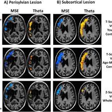 Yo maps mary you x d mary grace lolo top lolo bottom. Pdf Meg Based Detection And Localization Of Perilesional Dysfunction In Chronic Stroke
