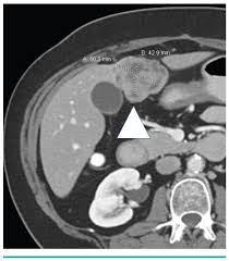 Image result for Leiomyosarcoma