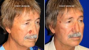 If you have skin cancer, it is important to know which type you have because it affects your treatment options and your outlook (prognosis). Skin Cancer Reconstruction Mohs Surgery Nj