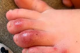 Menghilangkan darah manis pada kaki / kenali beragam cara menghilangkan mata ikan yang kerap kali tumbuh di kaki dan bisa sangat sebagai catatan, penderita penyakit diabetes atau kencing manis sama sekali tidak boleh mengobati sendiri caranya, gosokkan getah jarak pada daerah yang terkena mata ikan secara rutin untuk. Covid Toes Benarkah Ciri Virus Corona Yang Muncul Di Jari Kaki Halaman All Kompas Com