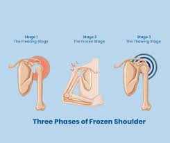 Image result for Frozen Shoulder