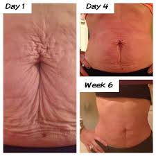 Before After Exclusive Skincarenow Info Loose Skin Tighten Loose Skin Galvanic Body Spa