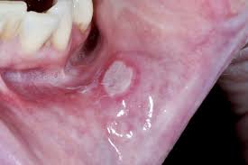 Check for color changes or colored patches inside your mouth. Mouth Ulcers Nhs