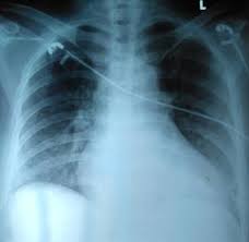 Thorax (plural thoraces or thoraxes). Gambar 4 Rongen Thorax Pa Cardiomegali Dan Pulmo Dalma Batas Normal Download Scientific Diagram