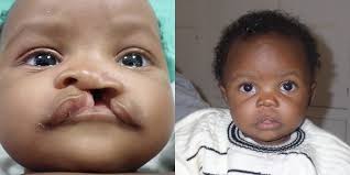 Image result for Cleft Lip