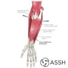 The tear creates swelling and pressure on the tendon which leads to inflammation and the symptoms of forearm tendonitis are the same as any other type of tendonitis (except calcific tendonitis). Body Anatomy Upper Extremity Tendons The Hand Society