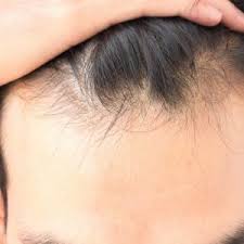 Prenota la tua visita gratuita da istituto helvetico sanders, centri tricologici leader per i trapianti con tecnica fue. Trapianto Capelli Torino Trapianto Di Capelli Forum Estheticon It