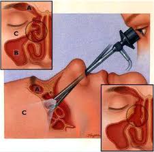 It may be done in combination with other the surgery is performed through your nostrils. Nasal Polyp India Nasal Polyp Removal Surgery Cost Nasal Polyp Surgery