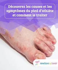 Causes Symptomes Et Traitements Du Pied D Athlete Ameliore Ta Sante Maladie Des Pieds Mycose Orteil Mycose Entre Les Orteils